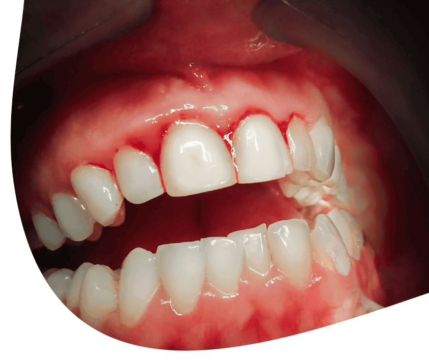 gums are bleeding